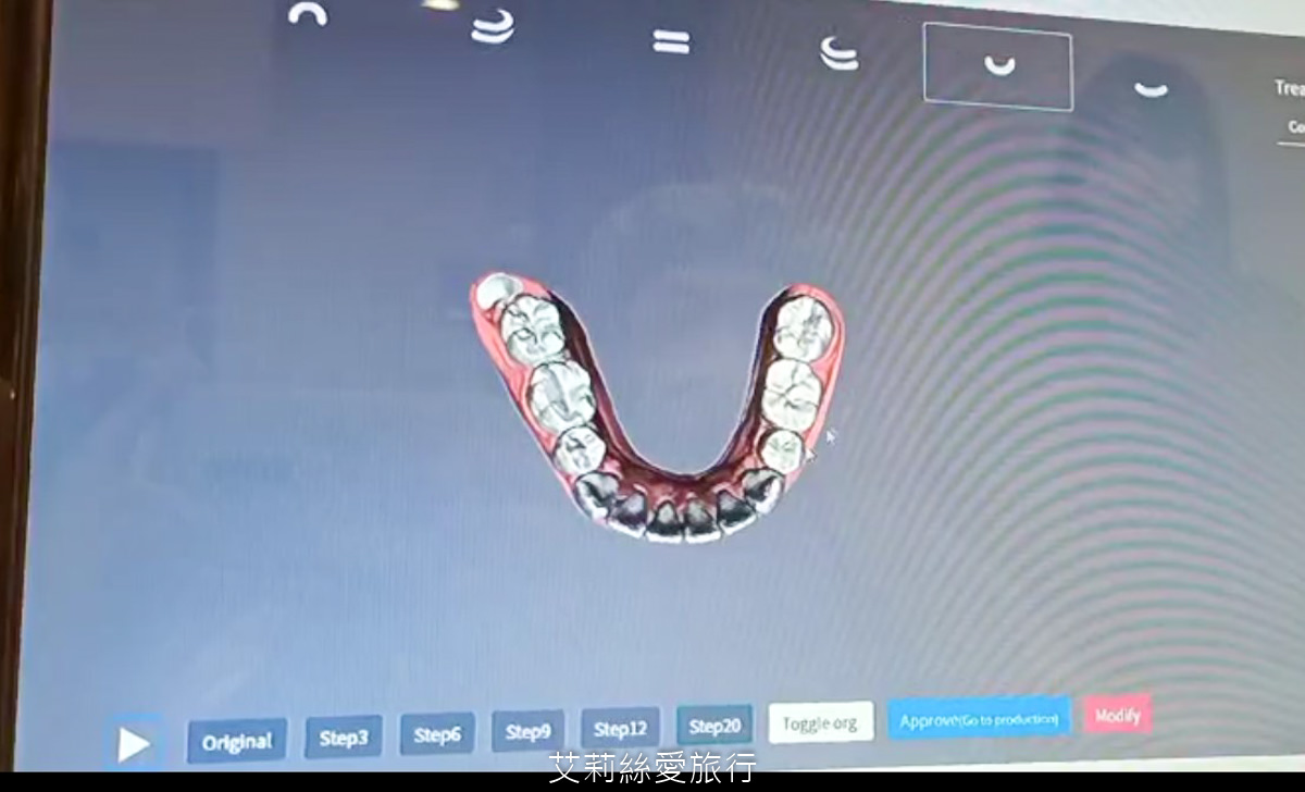YA!SMILE隱形牙套諮詢會先進行數位口掃
